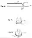 Fig. 11 - Autoflush syringe