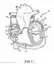 Fig. 02 - Steerable and shapable catheter employing fluid force