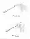 Fig. 07 - Guidewire retrieval member for catheter insertion