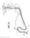 Fig. 18 - Feeding tube