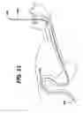 Fig. 20 - Feeding tube