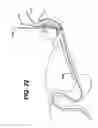 Fig. 21 - Feeding tube