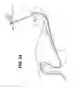 Fig. 23 - Feeding tube