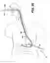 Fig. 25 - Feeding tube