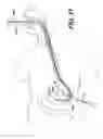 Fig. 26 - Feeding tube