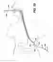 Fig. 28 - Feeding tube