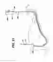 Fig. 30 - Feeding tube