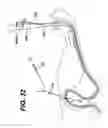 Fig. 31 - Feeding tube