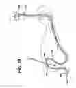 Fig. 32 - Feeding tube