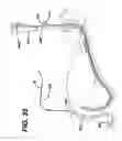Fig. 34 - Feeding tube