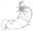 Fig. 01 - Method for vacuum-assisted tissue ablation