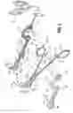 Fig. 04 - Vessel sealing forceps with disposable electrodes