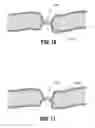 Fig. 08 - Vessel sealing forceps with disposable electrodes