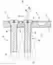 Fig. 01 - Plate system for securing bone or bone fragments