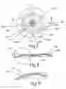 Fig. 06 - Cranial bone flap fixation system and method