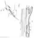 Fig. 02 - Apparatus and method for positive closure of an internal tissue membrane opening
