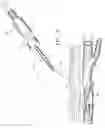 Fig. 04 - Apparatus and method for positive closure of an internal tissue membrane opening