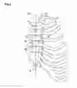 Fig. 03 - Blunt intercostal suture needle
