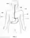 Fig. 02 - Expandable sheath for percutaneous upper gastrointestinal tract access