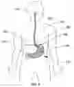Fig. 03 - Expandable sheath for percutaneous upper gastrointestinal tract access