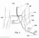 Fig. 04 - Expandable sheath for percutaneous upper gastrointestinal tract access