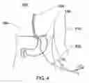 Fig. 05 - Expandable sheath for percutaneous upper gastrointestinal tract access