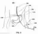 Fig. 06 - Expandable sheath for percutaneous upper gastrointestinal tract access