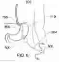 Fig. 09 - Expandable sheath for percutaneous upper gastrointestinal tract access