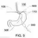 Fig. 10 - Expandable sheath for percutaneous upper gastrointestinal tract access