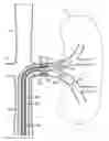 Fig. 01 - Bifurcated artery filter system