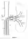 Fig. 02 - Bifurcated artery filter system
