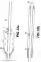 Fig. 15 - Embolic protection device