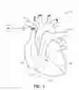 Fig. 02 - System with left/right pulmonary artery electrodes