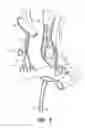 Fig. 04 - System with left/right pulmonary artery electrodes