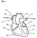 Fig. 02 - Apparatus and method for optimizing atrioventricular delay