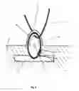 Fig. 09 - Transcutaneous power and/or data tranceiver system