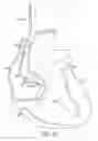 Fig. 04 - Lead and catheter assembly