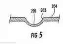 Fig. 06 - Esophageal stent and associated method
