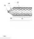 Fig. 02 - Apparatus and method for anchoring endoluminal prostheses in tortuous geometries