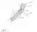 Fig. 07 - Apparatus and method for anchoring endoluminal prostheses in tortuous geometries