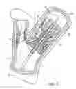 Fig. 09 - Vascular stent for embolic protection
