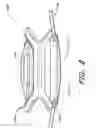 Fig. 09 - Accommodating intraocular lens system