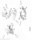 Fig. 08 - Pectus bar stabilizer