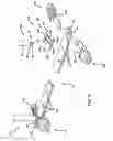 Fig. 10 - Pectus bar stabilizer