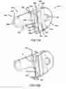 Fig. 11 - Pectus bar stabilizer