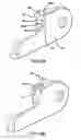 Fig. 12 - Pectus bar stabilizer