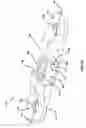Fig. 15 - Pectus bar stabilizer