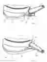 Fig. 06 - Tibial cement skirt assembly