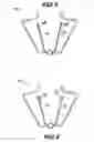 Fig. 04 - Nasal appliance