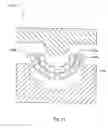Fig. 26 - Use of a metal and Sn as a solvent material for the bulk crystallization and sintering of diamond to produce biocompatbile biomedical devices
